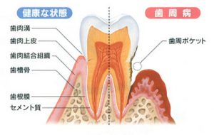 歯周病原因