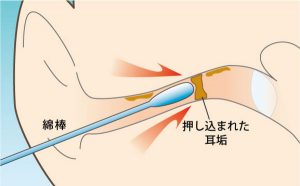 耳垢栓塞の原因