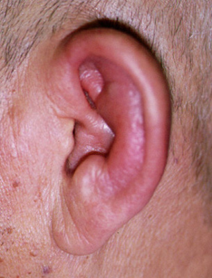 耳介軟骨膜炎