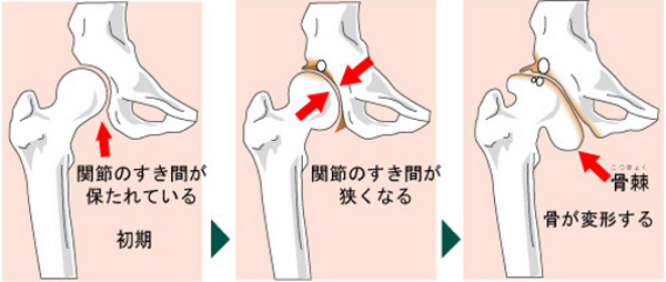 変形股関節症の進行