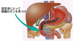 超音波内視鏡検査