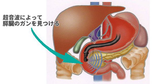 超音波内視鏡検査