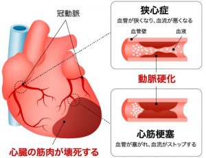 虚血性心不全