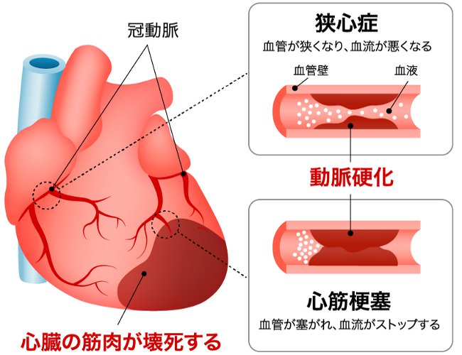 虚血性心不全