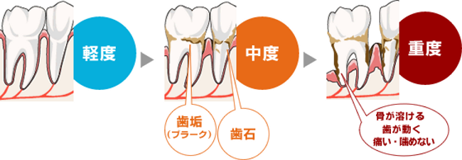 歯槽膿漏